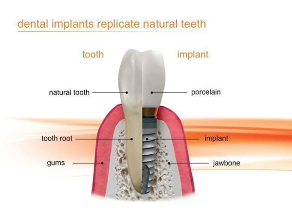 Dental Implant and Natural Tooth Comparison Diagram
