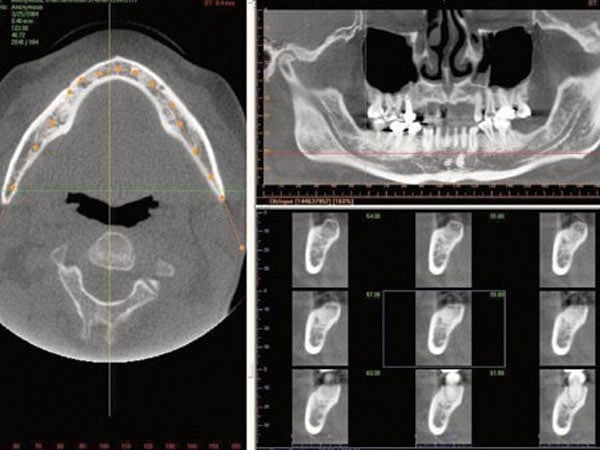 An x-ray of teeth
