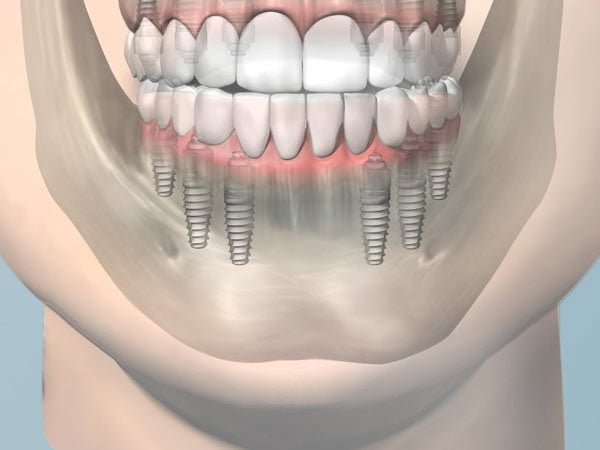 Cascades Dental Hybrid Restorations