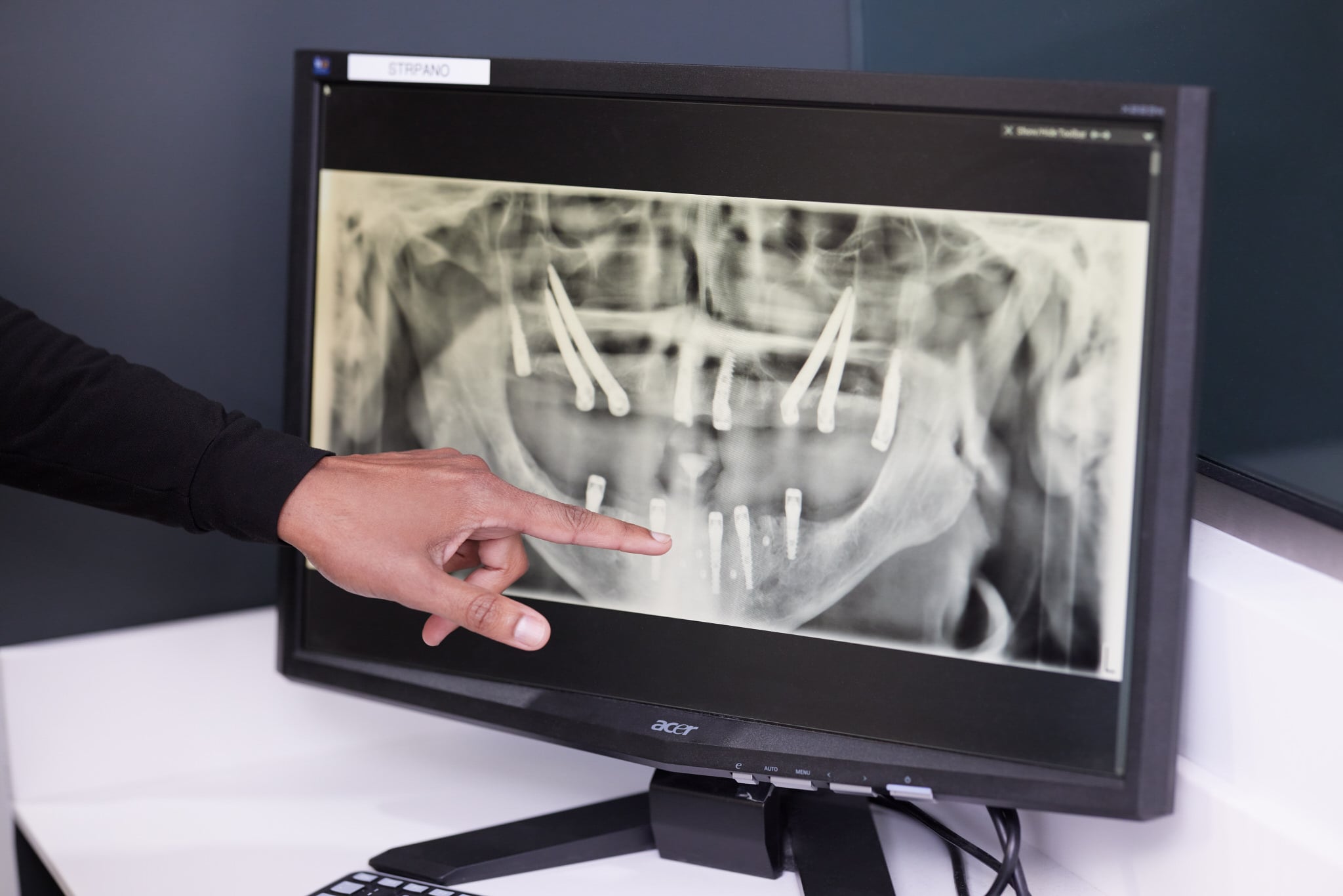 Doctor outlining how ArchONE implants work