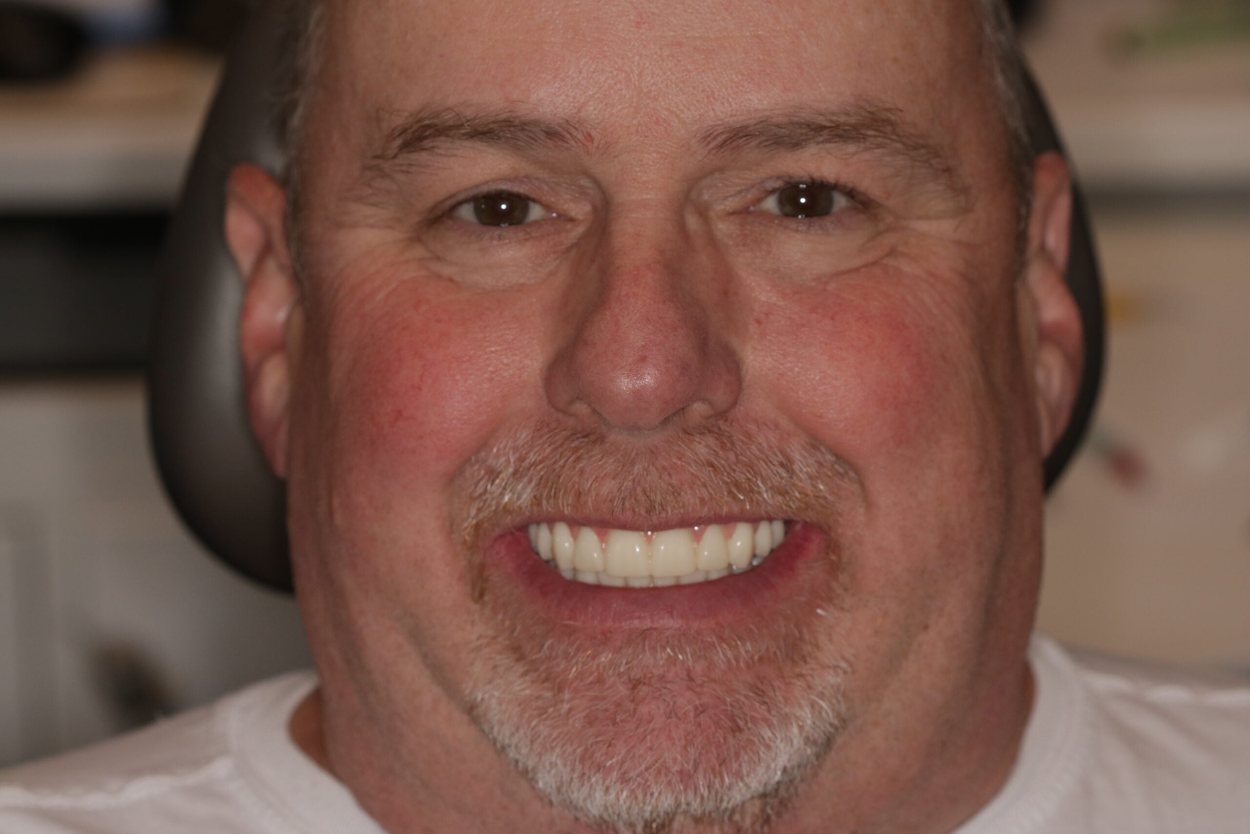 Potter's Smile Following Full Arch Implant Treatment