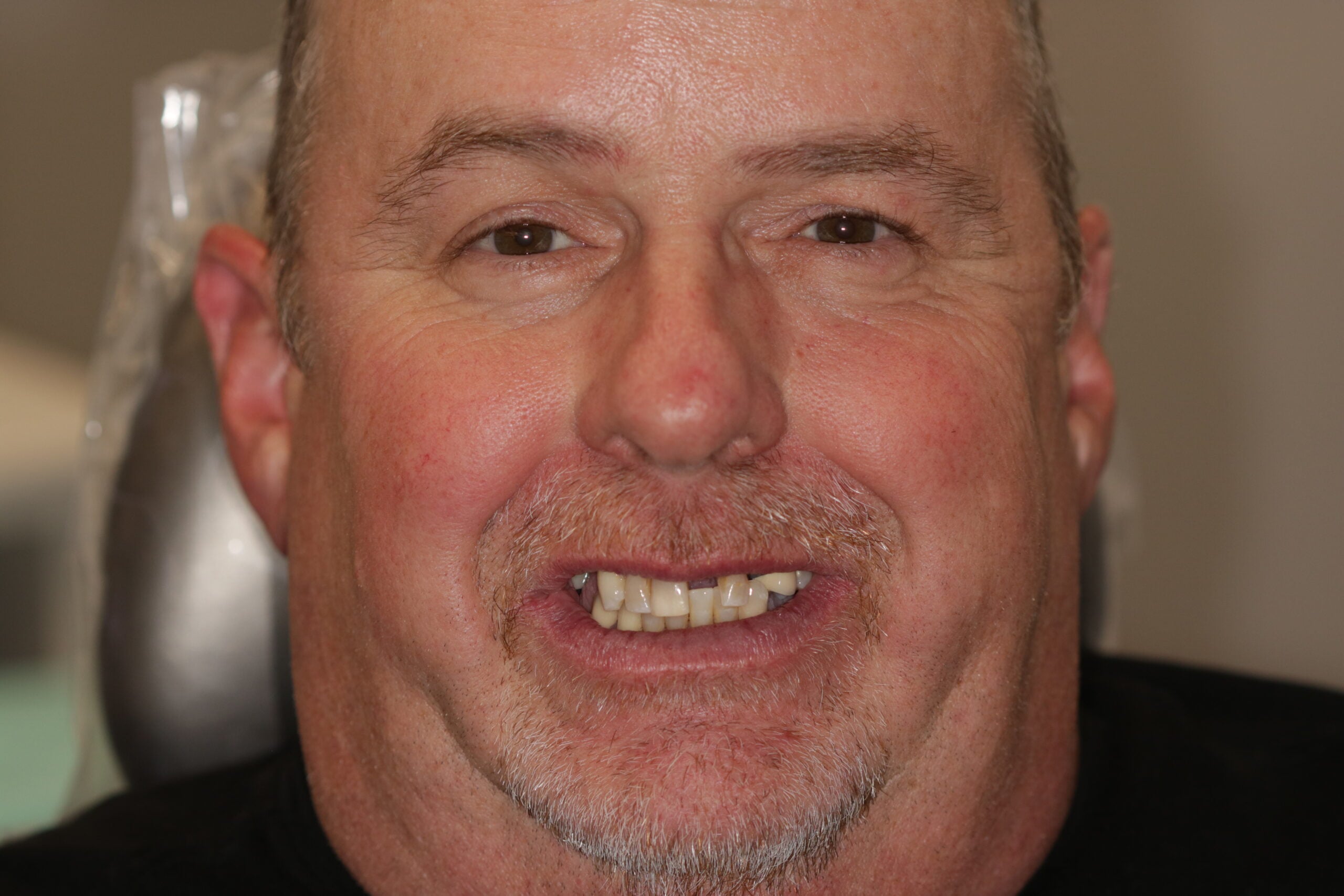 Potter's Smile Prior to Full Arch Implant Treatment