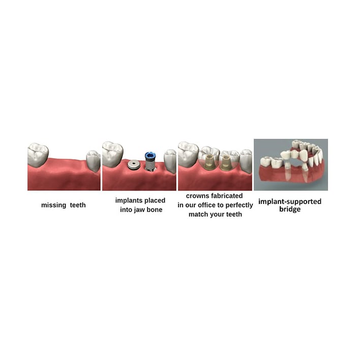 Multiple Implants