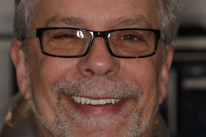 Ahier's Smile Following Full Mouth Dental Implants