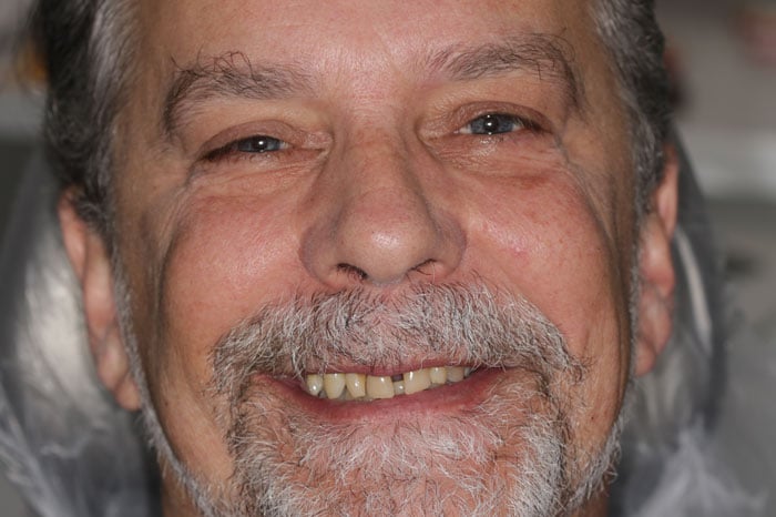 Ahier's Smile Prior to Full Mouth Dental Implants