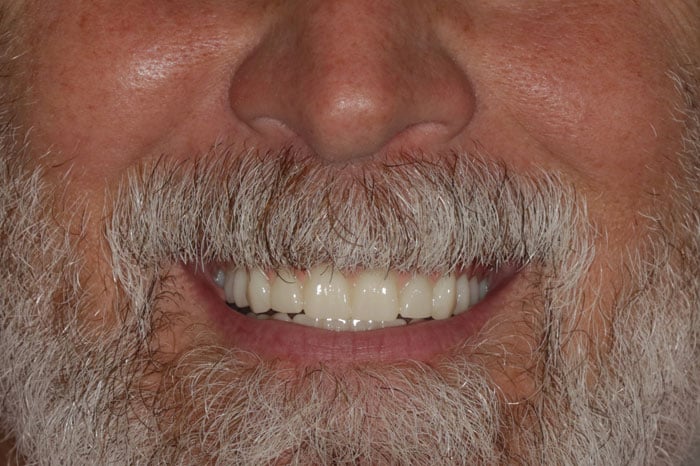 Man's Smile Following Dental Implant Treatment