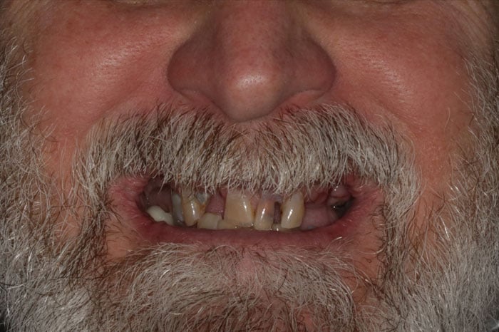 Man's Pre-Treatment Smile Before Dental Implants