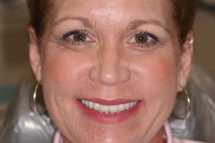 Annice's Smile Following Dental Crown Treatment