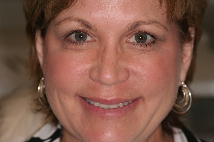 Annice's Smile Prior to Dental Crowns