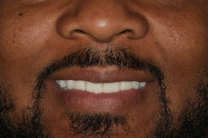 Post-Op Implant Installation