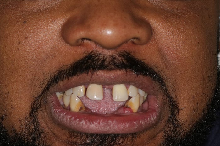 Man's Initial Smile Before Dental Implants