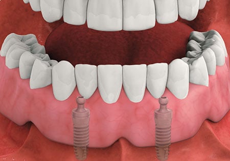 
Implant-Supported Overdentures