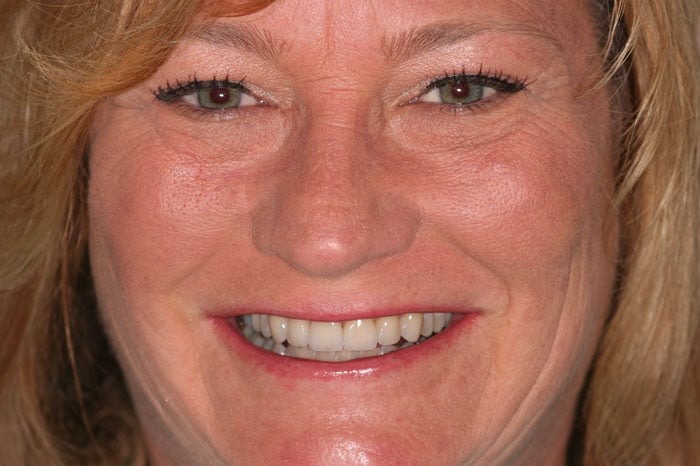 Connie's Smile Following Dental Crown Restoration