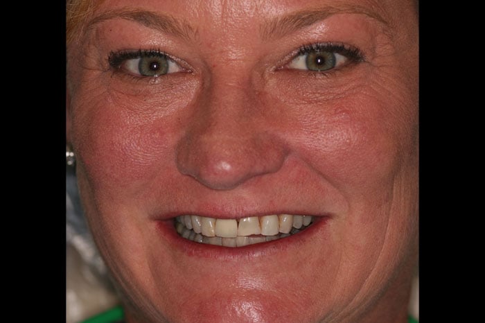 Connie's Smile Prior to Dental Crowns