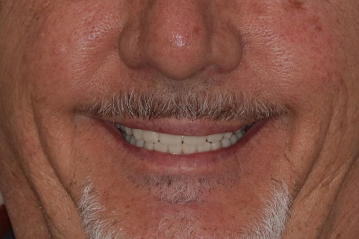 Man's Smile Following ArchONE Dental Implants