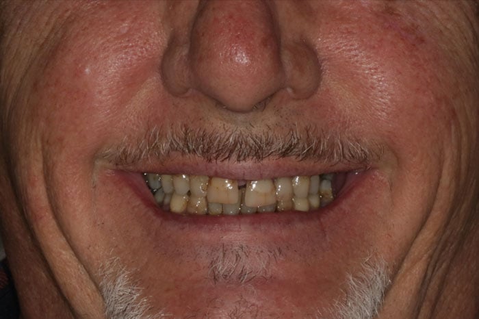 Man's Smile Prior to ArchONE Dental Implants
