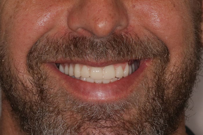 Male Post-Treatment Smile With Implants