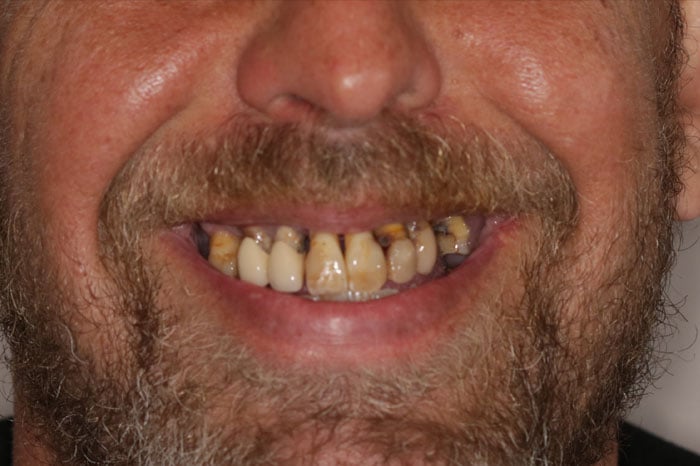 Male Pre-Treatment Smile Before Implants