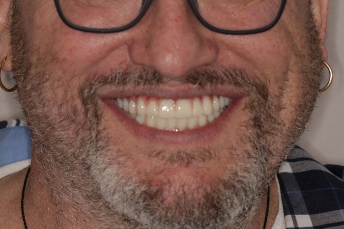 Man's Smile Following Full Arch Zirconia Implants