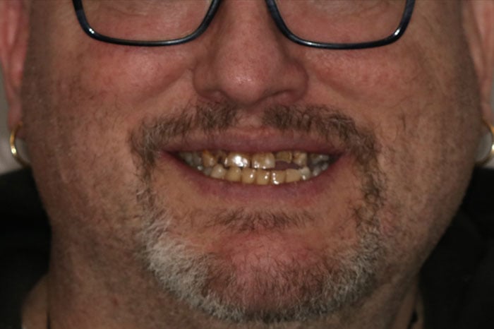 Man's Smile Prior to Full Arch Zirconia Implants