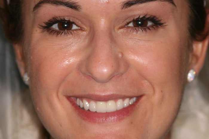 Ginny's Smile Following Cosmetic Crown Treatment