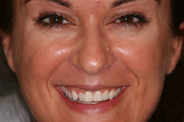 Ginny's Smile Prior to Crown Treatment