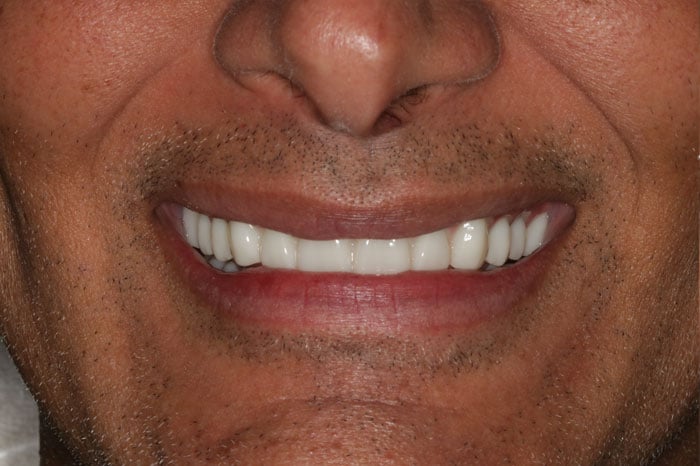 Male After Smile Restoration