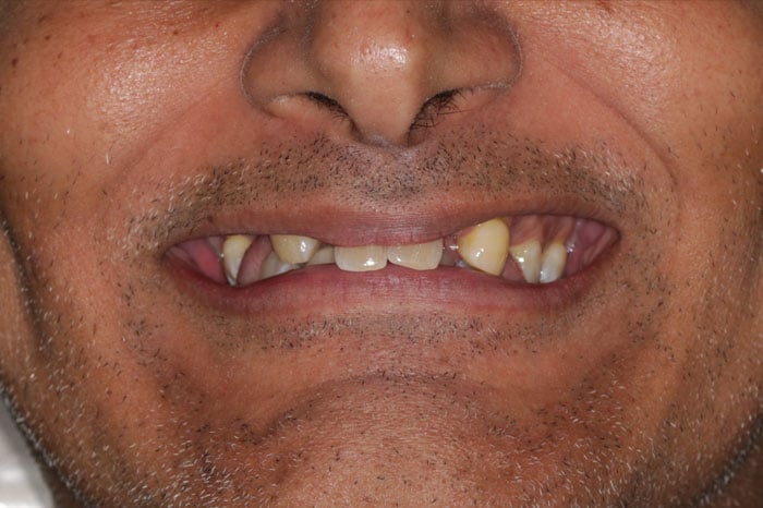 Male Before Smile Restoration