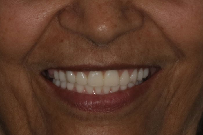 Woman's Smile Following ArchONE Full Mouth Implants