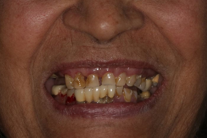 Woman's Smile Prior to ArchONE Full Mouth Implants