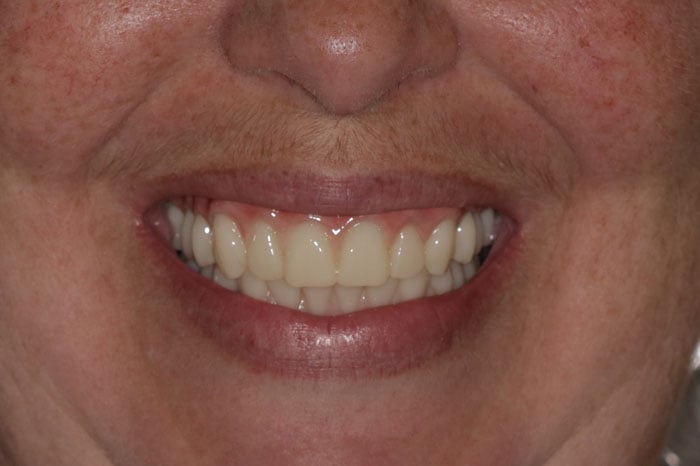 Woman's Smile Following Full Mouth Restoration