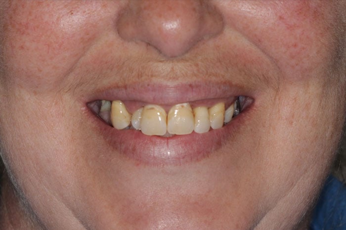 Woman's Smile Prior to Full Mouth Restoration