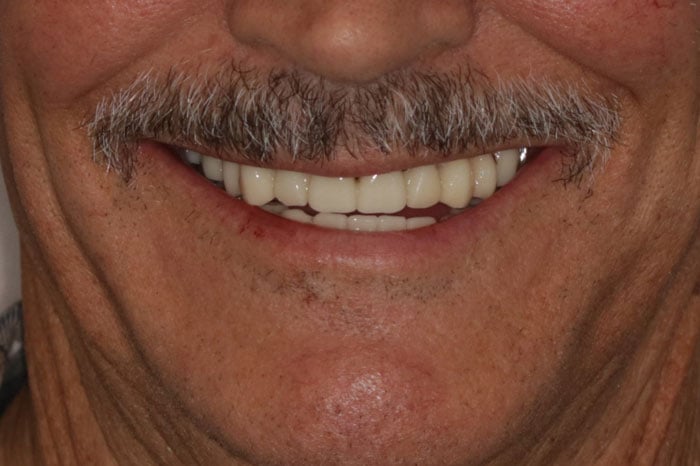 Man's Smile Following Advanced Implant Treatment