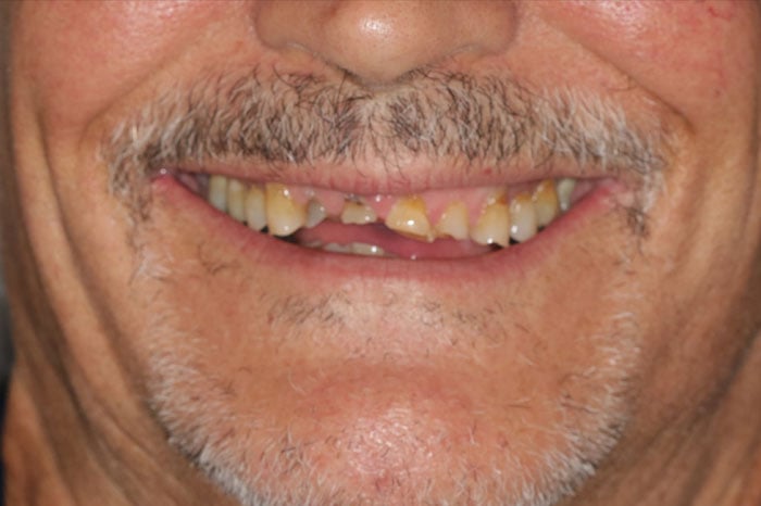 Man's Smile Prior to Advanced Implant Treatment