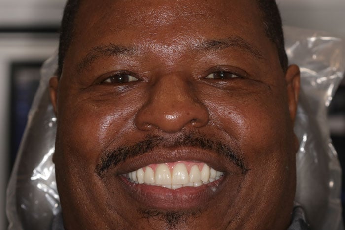 Rhodes' Smile Following ArchONE Dental Implants