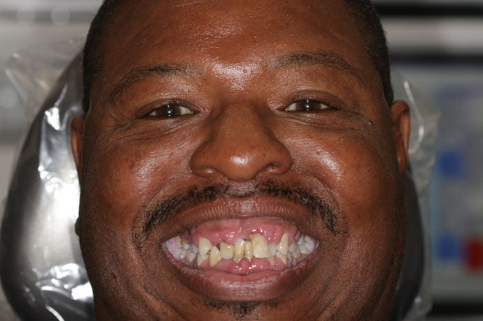 Rhodes' Smile Prior to ArchONE Dental Implants
