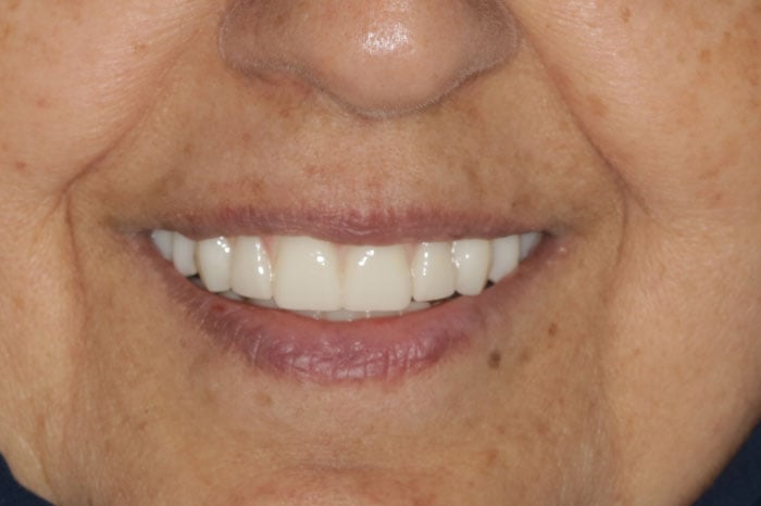 Woman's Original Smile After Dental Implants Treatment