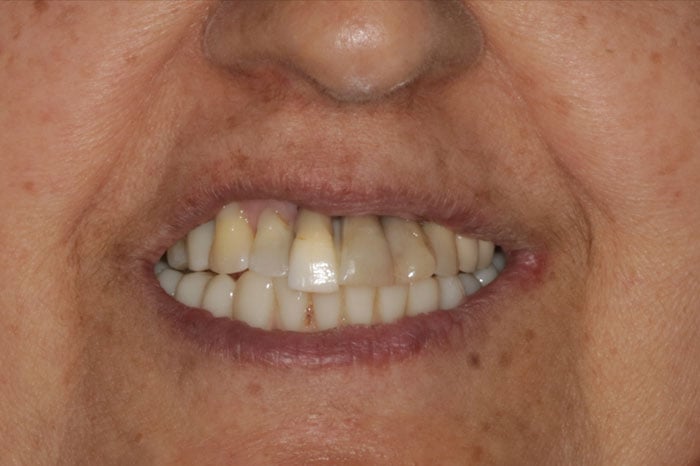 Woman's Original Smile Before Dental Implants