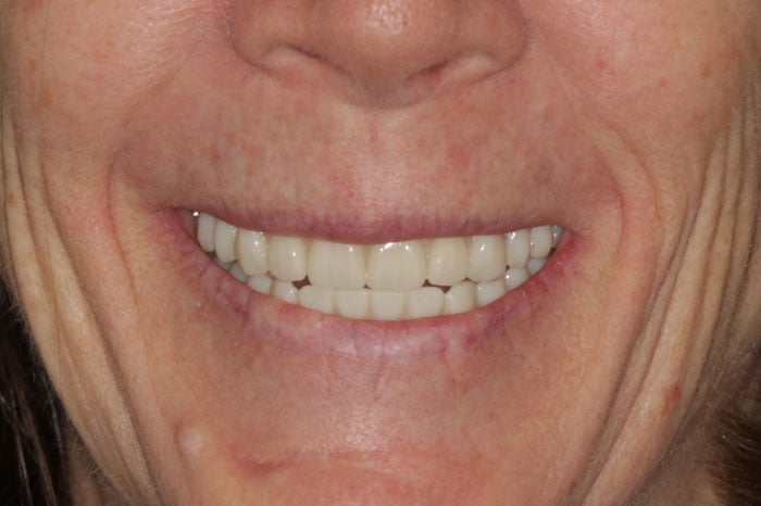 Woman's Smile Prior to Dental Implants