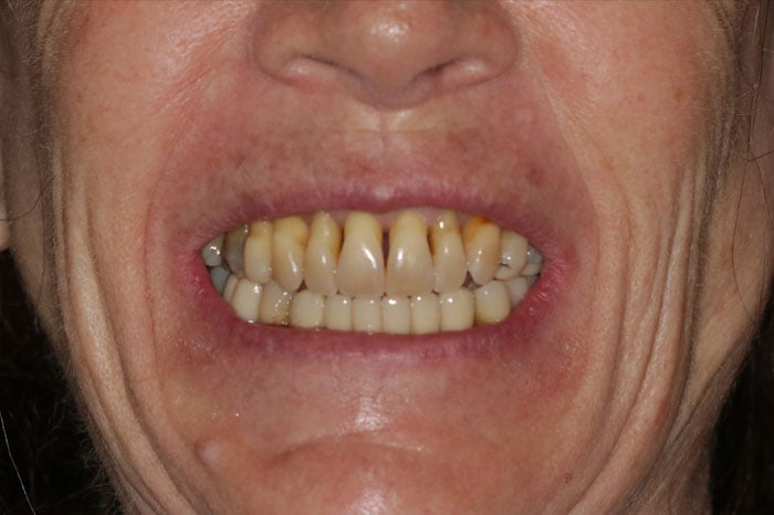 Woman's Smile Prior to Dental Implants