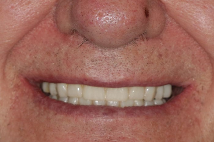 Man's Smile Following Comprehensive Dental Implant Treatment