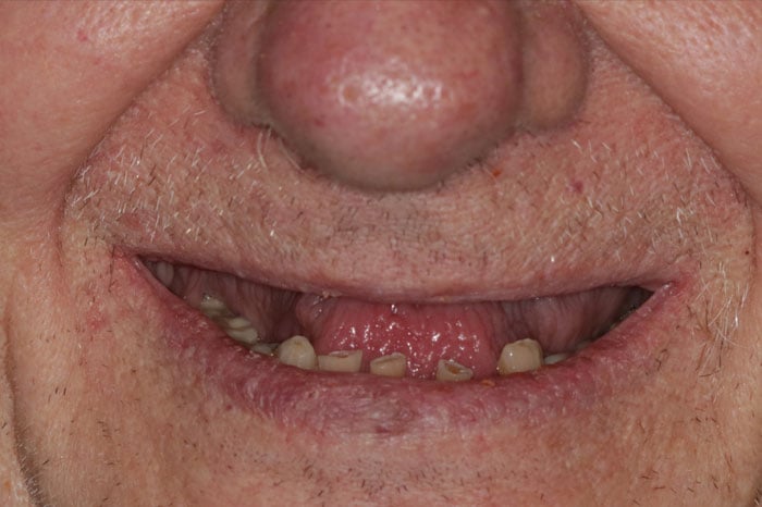 Man's Smile Prior to Comprehensive Dental Implant Treatment