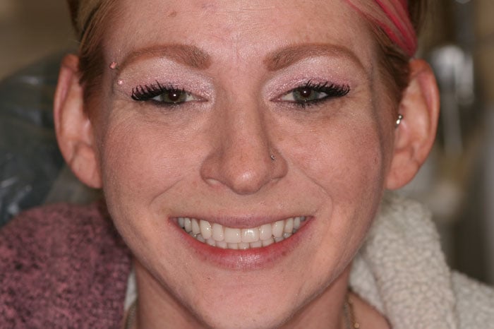 Woman's Smile Succeeding Dental Implants