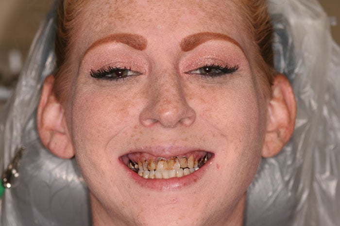 Woman's Smile Preceding Dental Implants